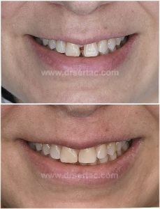 Ön iki diş aralığı nasıl kapandı? Diastema tedavisi önce sonra fotoğrafı