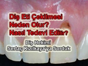 Kaplama diş ve diş eti çekilmesi