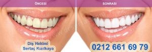 diş beyazlatma önce sonra
