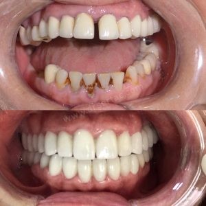 eski diş kaplama yerine yenisi