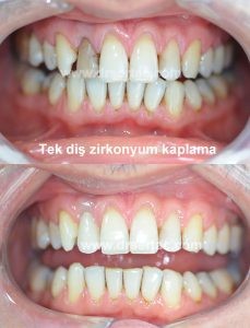 Kanal tedavisi nedeni ile oluşan diş renklenmesinde tek diş zirkonyum kaplama ile çözüm