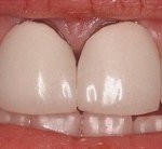 Metal porselen diş kaplama kenarında diş eti renklenmesi