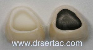 Solda zirkonyum diş kaplama sağda metal porselen diş kaplama görmektesiniz.