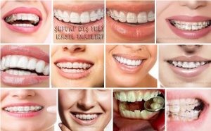 Şeffaf diş teli orthero invisalign