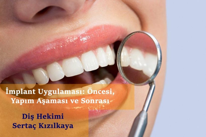 implant yapımı