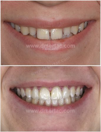 Ön iki diş aralığı kapatma Lamina