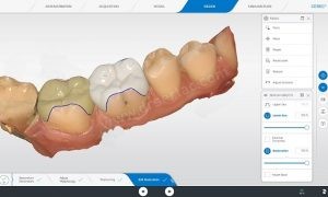 cerec yapımı