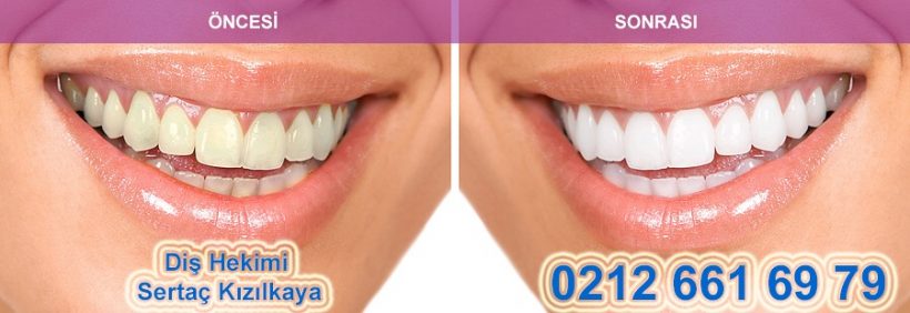 diş beyazlatma önce sonra