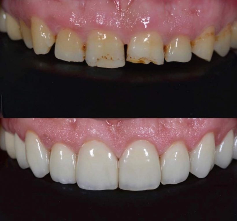 Kaplama Önce Sonra Diş Hekimi Sertaç Kızılkaya