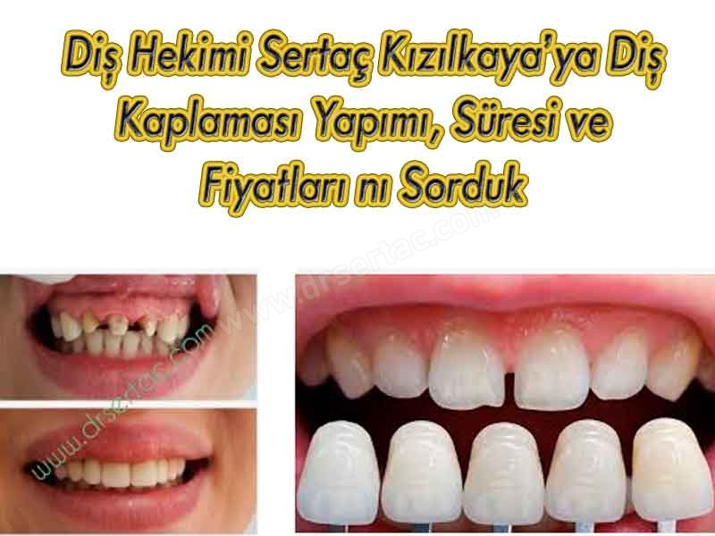 Diş kaplama süresi