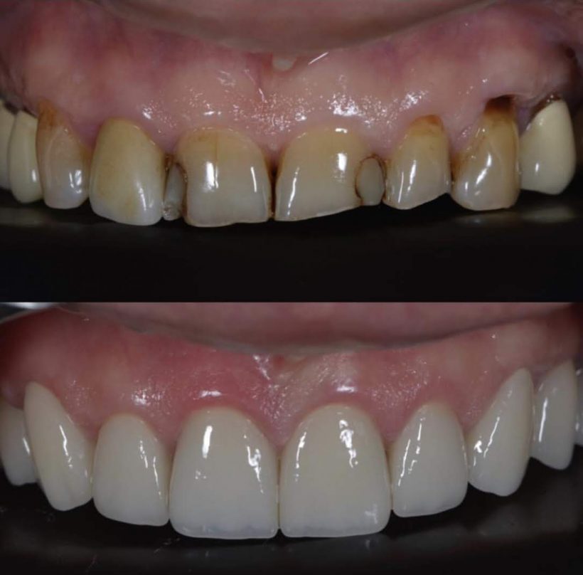 Estetik diş kaplama