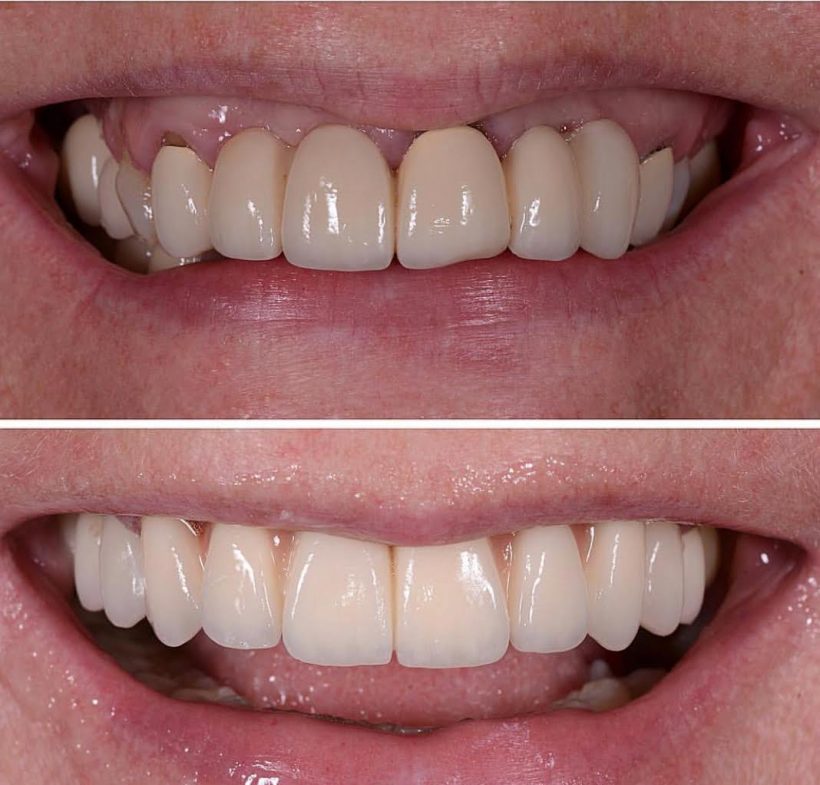 Eski Zirkonyum Kaplama Değişimi